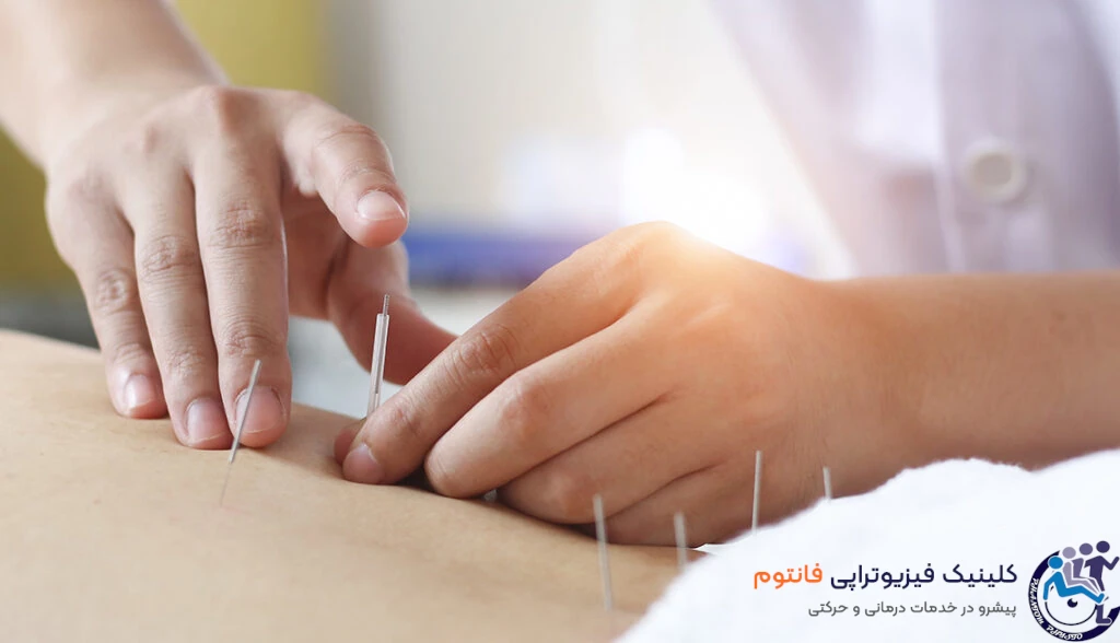 تاثیرات طب سوزنی در درمان دیسک کمر