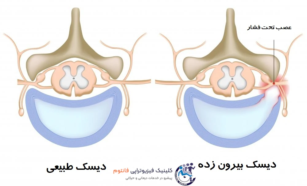 فشار دیسک کمر بر اعصاب کمر