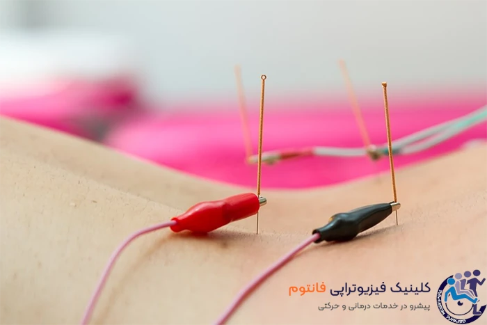 طب سوزنی در دیسک کمر